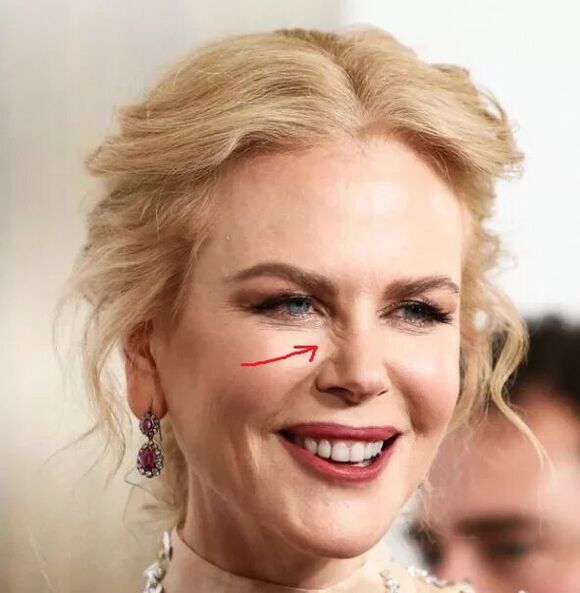 ជម្មើសជំនួសទៅ botox